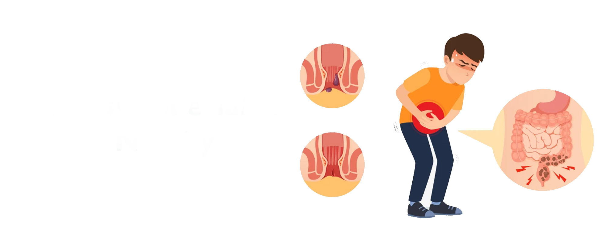 Fissure Surgery in Mogappair