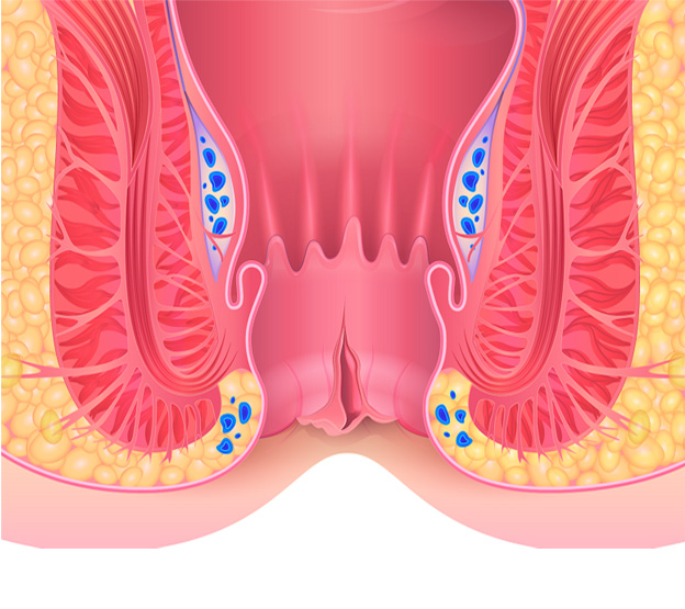 Fissure Surgery in Kolathur
