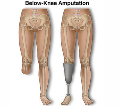 Amputation Surgery in Mogappair