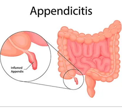 Appendicitis Surgery in Mogappair