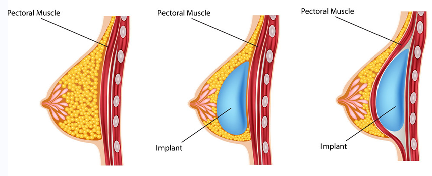Breast Abscess surgery in Kolathur