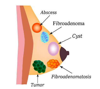 Breast Abscess Treatment in Mogappair