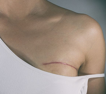 Breast Cancer Treatment in Mogappair