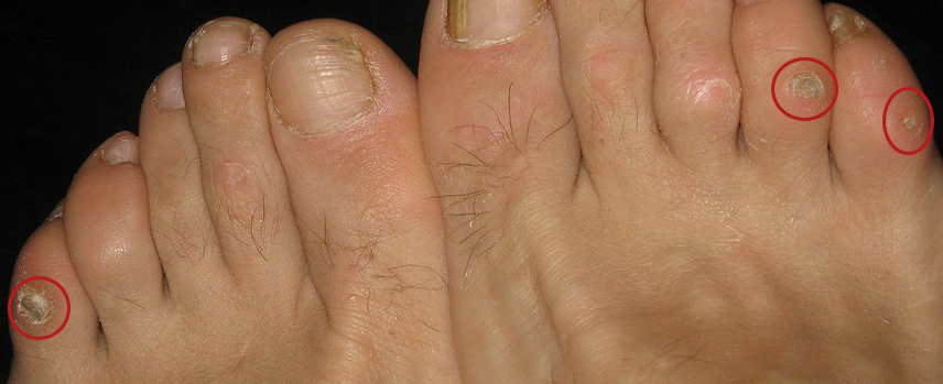 Corn Foot Treatment in Kolathur