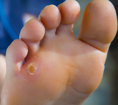 Corn Foot Treatment in Mogappair