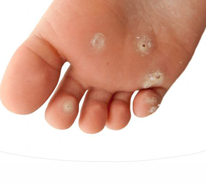 Corn Foot Surgery in Kolathur