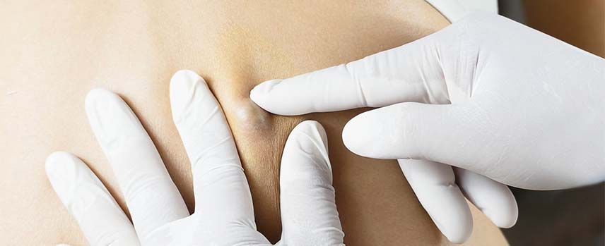 Dermoid Cyst Treatment in Kolathur