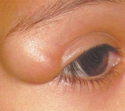 Dermoid Cyst Treatment in Mogappair