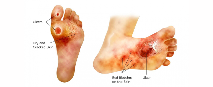 Diabetic Foot Treatment in Kolathur