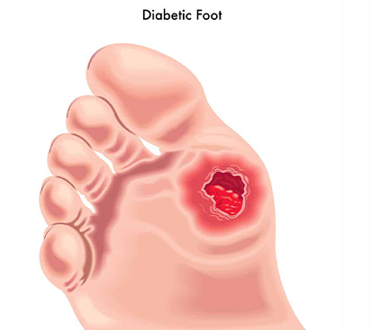 Diabetic Foot Treatment in Mogappair