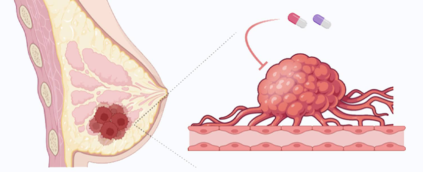 Fibroadenoma Treatment in Kolathur