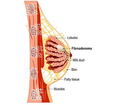 Fibroadenoma Treatment in Mogappair