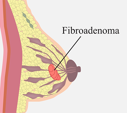 Fibroadenoma Surgery in Kolathur