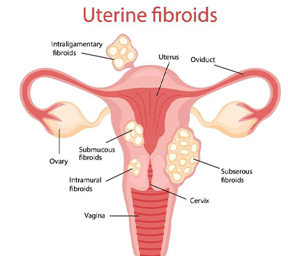 Uterine Fibroid Surgery in Kolathur