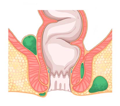 Fistula Treatment in Mogappair