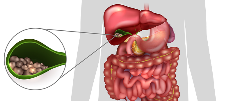 Gallbladder Stone Treatment in Kolathur