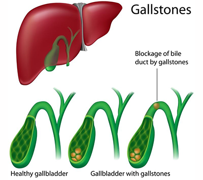 Gallbladder Stone Surgery in Mogappair