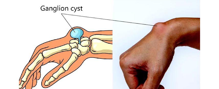 Ganglion Cyst Treatment in Kolathur