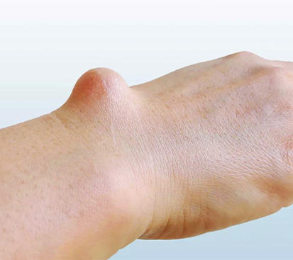 Ganglion Cyst Treatment in Mogappair