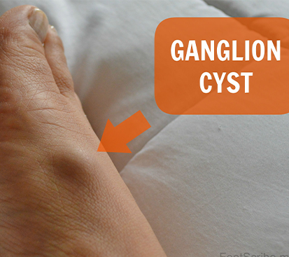 Ganglion Cyst Surgery in Kolathur