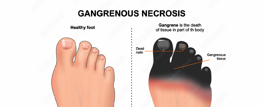Gangrene Foot Surgery in Kolathur