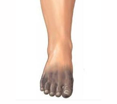 Gangrene Foot Surgery in Mogappair