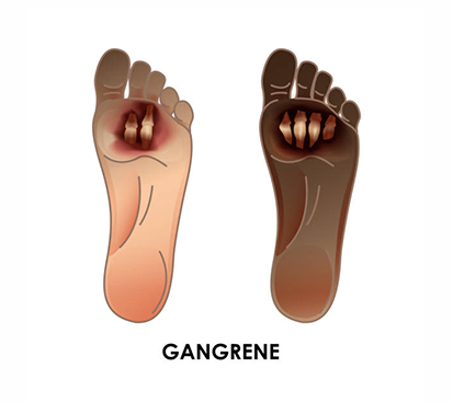 Gangrene Foot Treatment in Mogappair