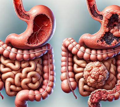 Gastric Cancer Treatment in Mogappair