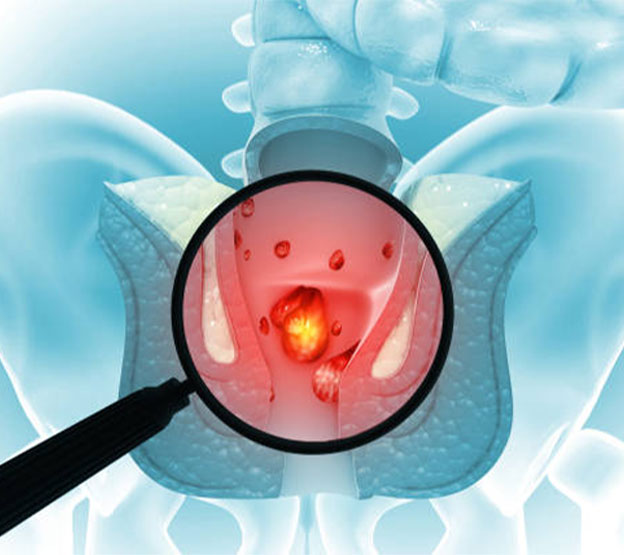 Best Piles Hospital in Kolathur