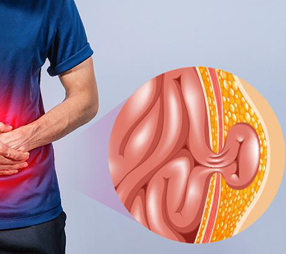 Hernia Surgery in Mogappair