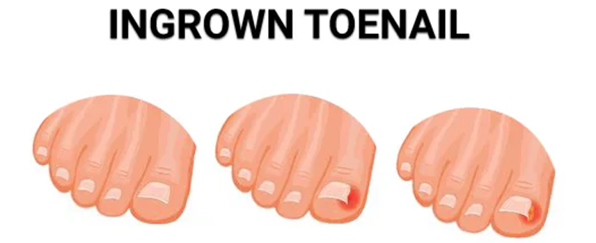 Ingrown Toenail Treatment in Kolathur