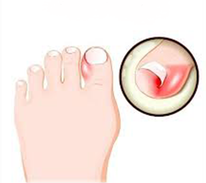 Ingrown Toenail Treatment in Mogappair