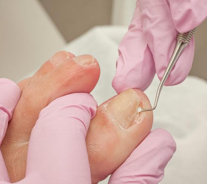 Ingrown Toenail Surgery in Kolathur