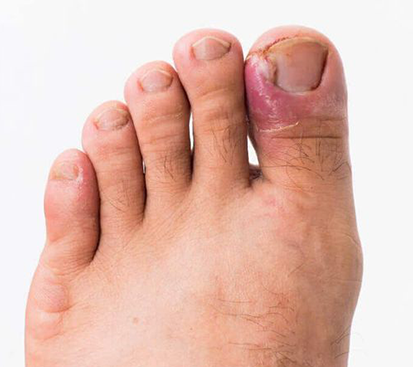 Ingrown Toenail Surgery in Mogappair
