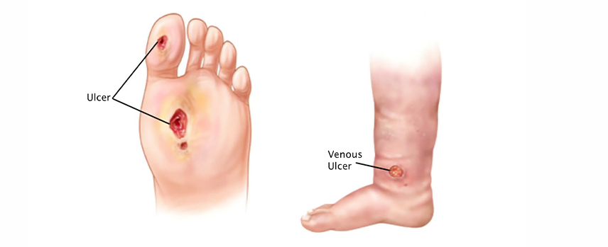 Non-Healing Foot Ulcer treatment in Kolathur