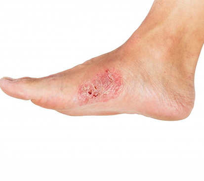 Non-Healing Foot Ulcer treatment in Mogappair