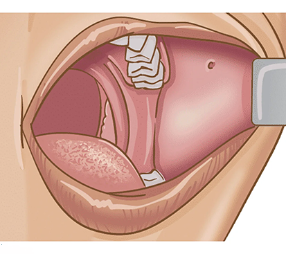 Oral Cavity Cancer Treatment in Mogappair