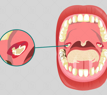Oral Cavity Cancer Treatment Cost in Kolathur