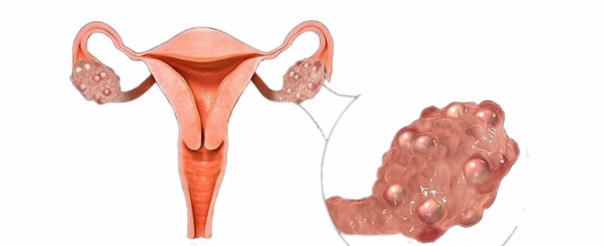 Ovarian Cyst Treatment in Mogappair