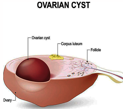 Ovarian Cyst Treatment in Kolathur