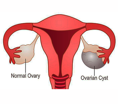 Ovarian Cyst Treatment Cost in Mogappair