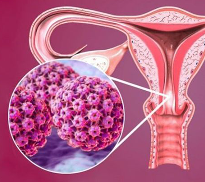 Uterine Cancer Treatment in Mogappair