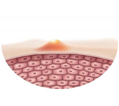 Sebaceous Cyst Treatment in Mogappair