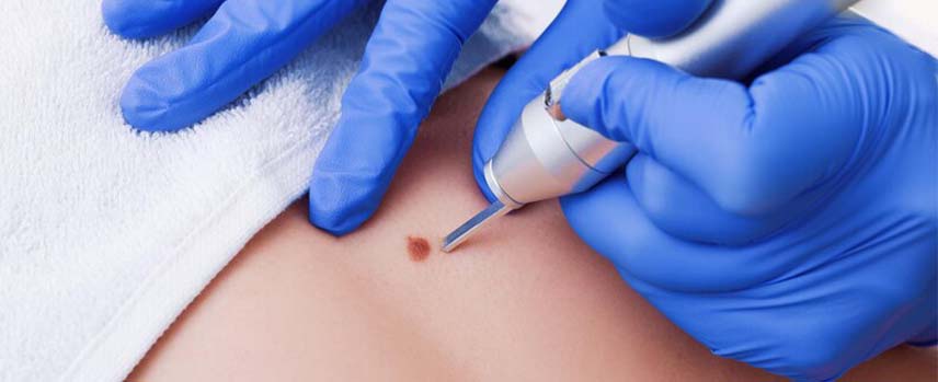 Sebaceous Cyst Treatment in Kolathur