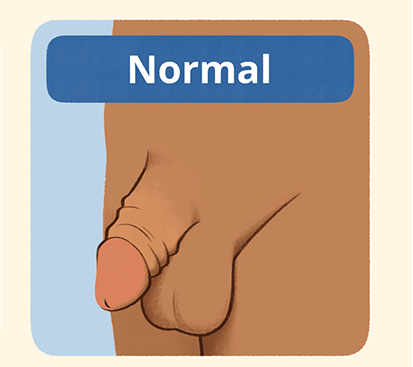 Foreskin Infection Treatment Cost in Kolathur