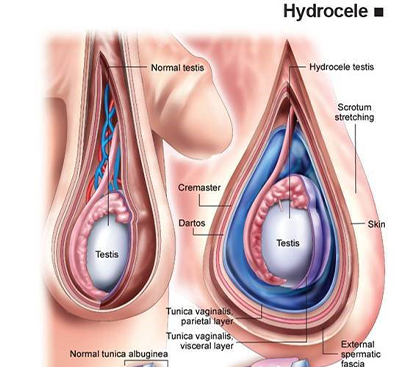 Hydrocele Surgery in Kolathur