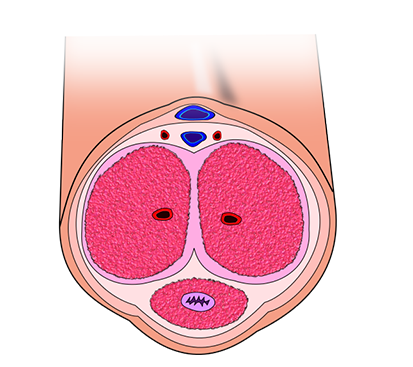 Balanitis and Balanoposthitis Surgery in Mogappair