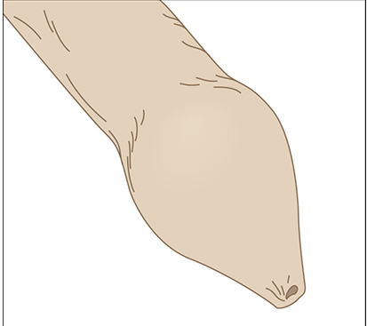 Paraphimosis Surgery in Mogappair