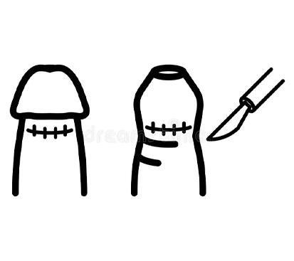 Phimosis Treatment in Mogappair