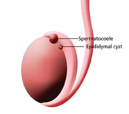 Testicular Torsion Surgery in Kolathur